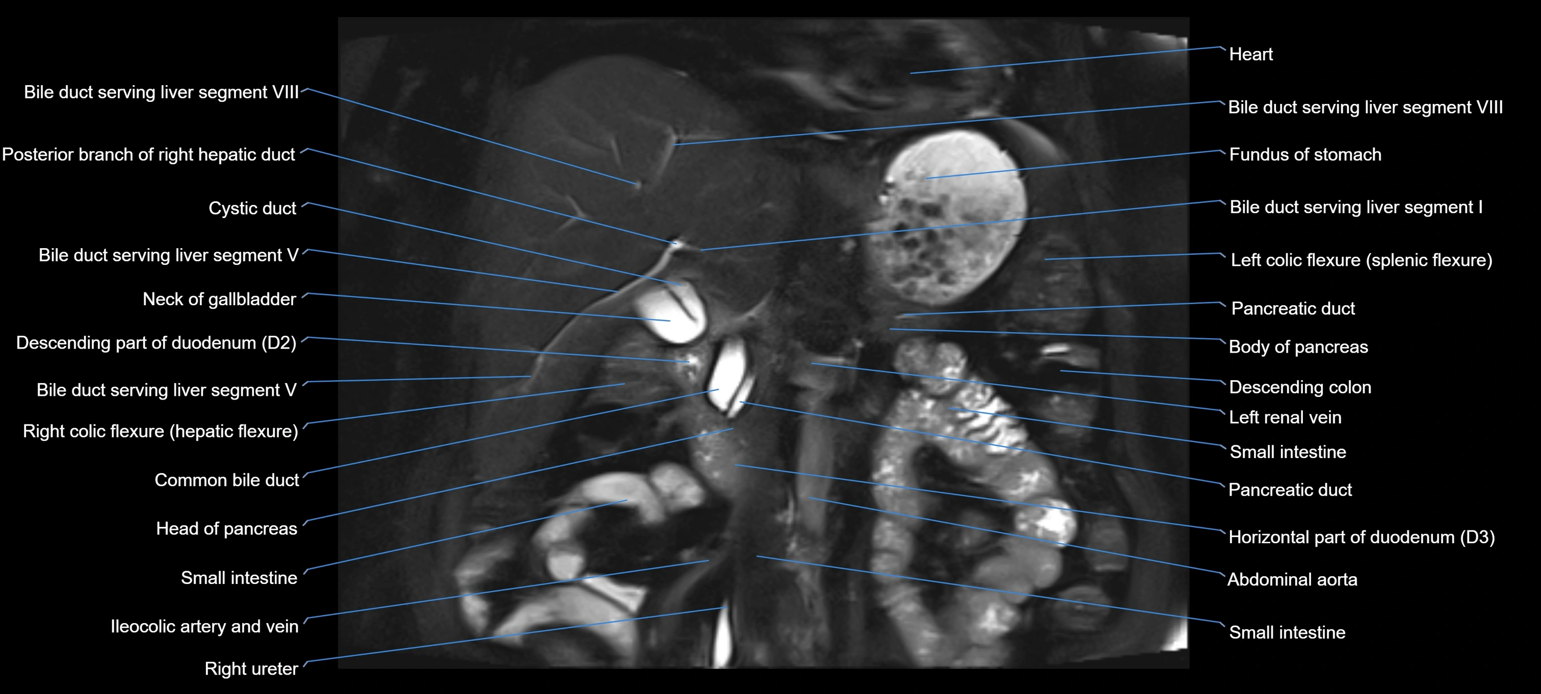 MRI MRCP coronal cross sectional 3T radiology  image-img-00001-00013.webp